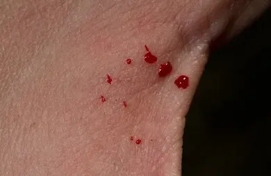 Snake Biting hindi news