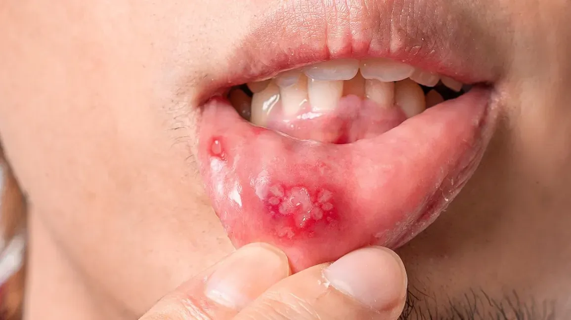 Vitamin Deficiency Symptoms Mouth Sores