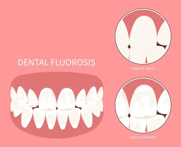 29 Dental Fluorosis Stock Vectors and Vector Art | Shutterstock