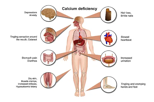 Calcium Deficiency: Causes & Symptoms