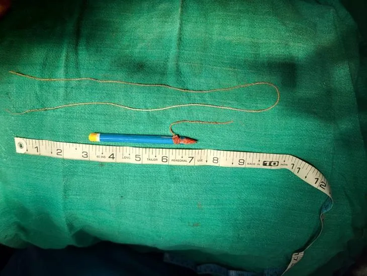 4 घंटे के ऑपरेशन के बाद बंदी के पेशाब नली से निकाली गई पेंसिल।