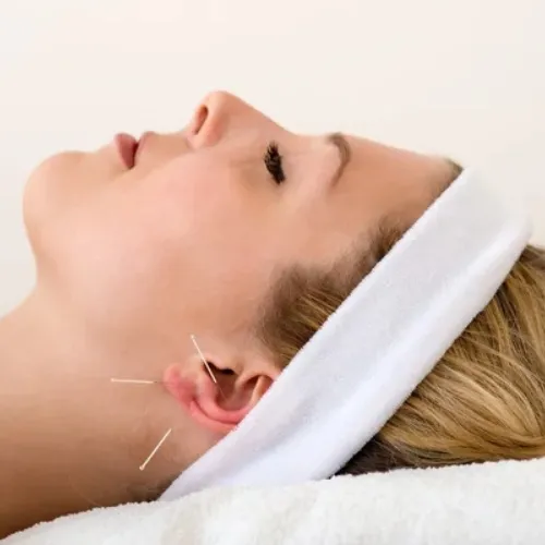 acupuncture