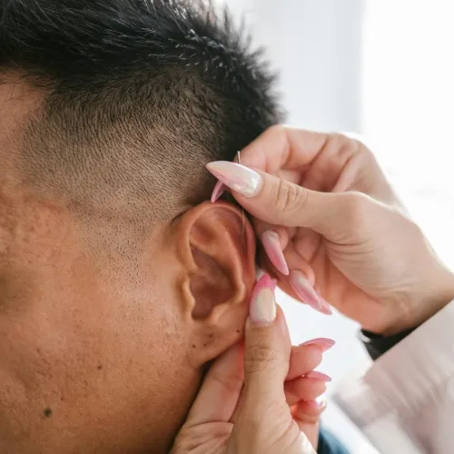 acupuncture