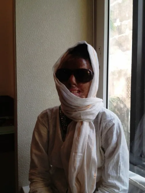Dhanbad-based Sonali Mukherjee, an acid attack survivor, does not want to be photographed openly till she undergoes her surgeries and looks 