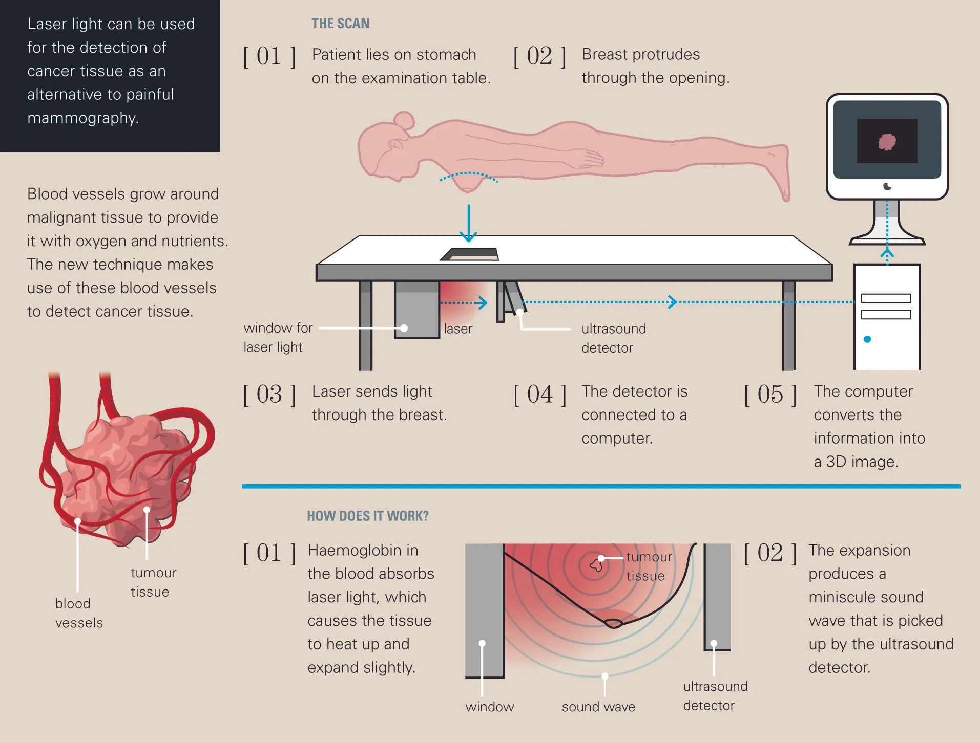 Schematic of Photo Acoustic Mammoscope Courtesy: Schwandt Infographics BV, The Netherlands. 