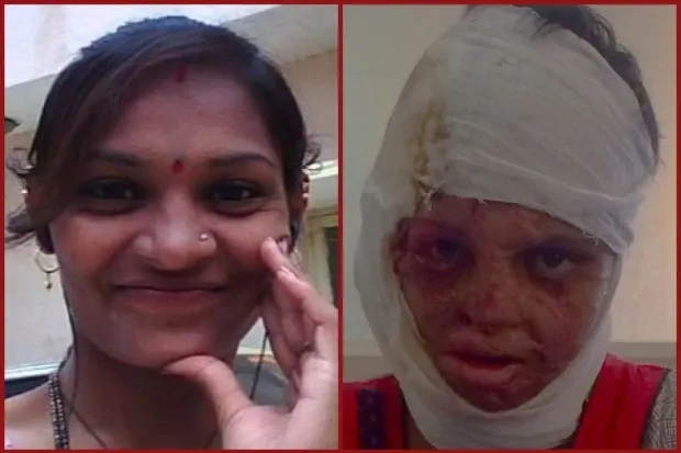 Rekha before and soon after the acid attack