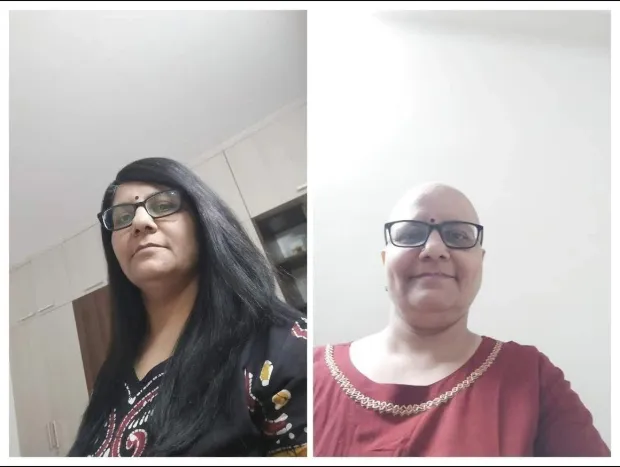 Alpa wearing a wig to encourage other cancer patients.