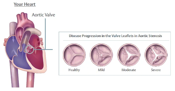 Aortic stenosis is a condition where the aortic valve in your heart narrows leading to a decrease in blood flow