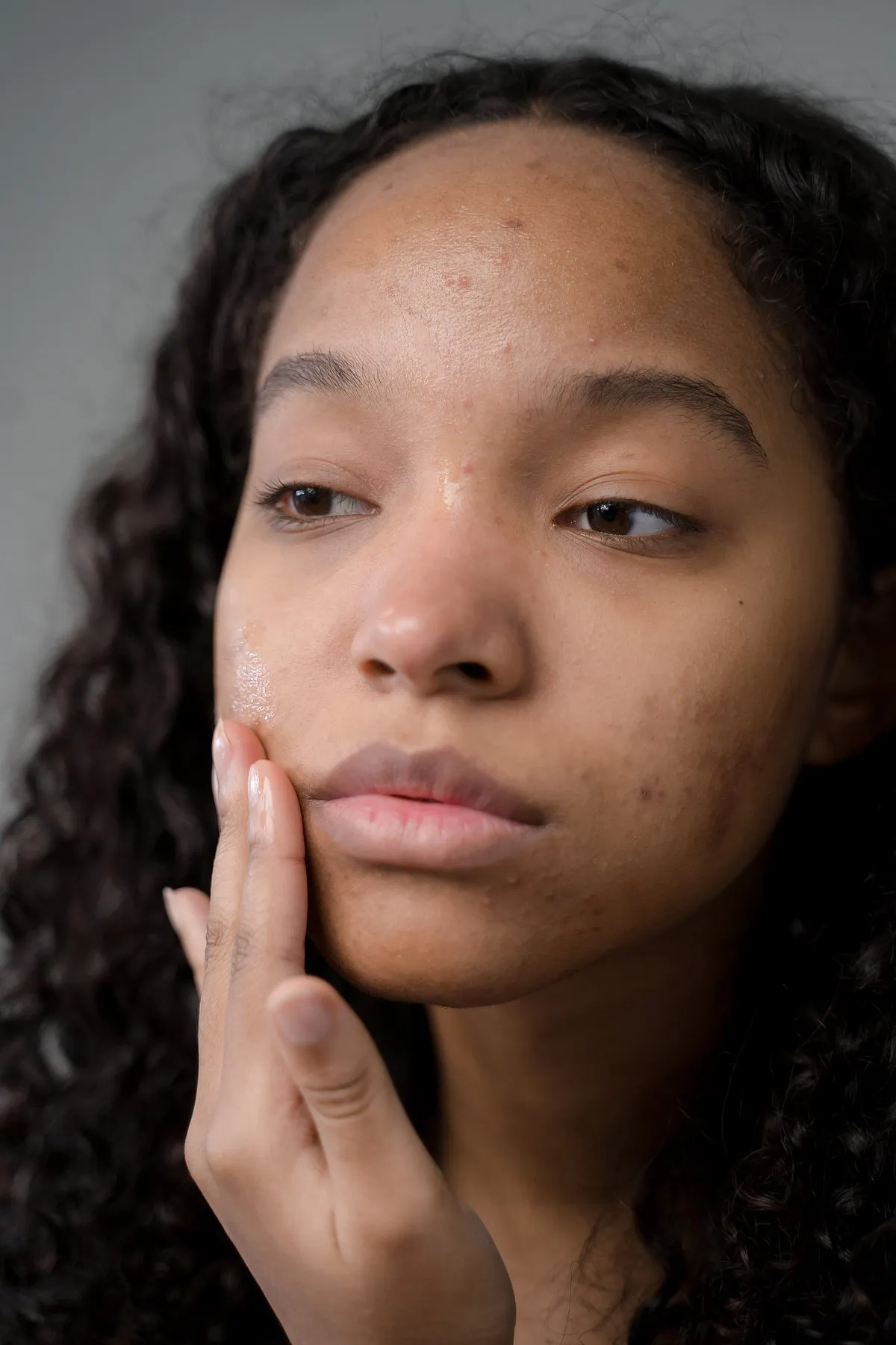 Different types of acne necessitate different treatments. Image: Pexels 