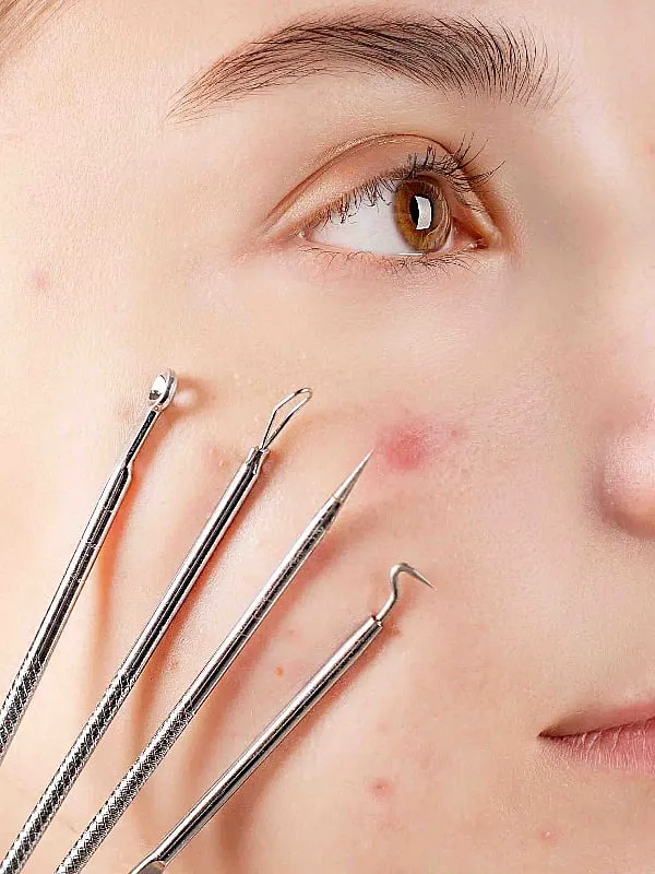 Dr Madhuri Agarwal advises against self-extracting acne at home as it can push it in deeper and worsen the problem. Image: Pexels 