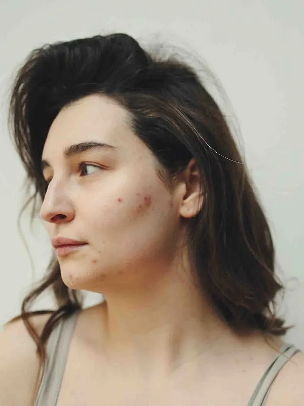 Dr Jaishree Sharad advises keeping away from oil-based and comedogenic products, which can aggravate acne by clogging the pores. Images: Pexels 