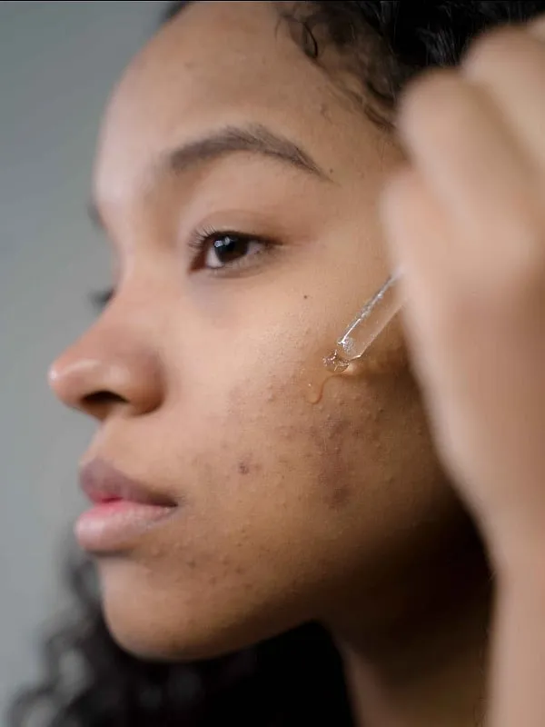 Dr Jaishree Sharad  says that people with sensitive skin may experience irritation, redness and a burning sensation upon using vitamin C products. Image: Pexels 