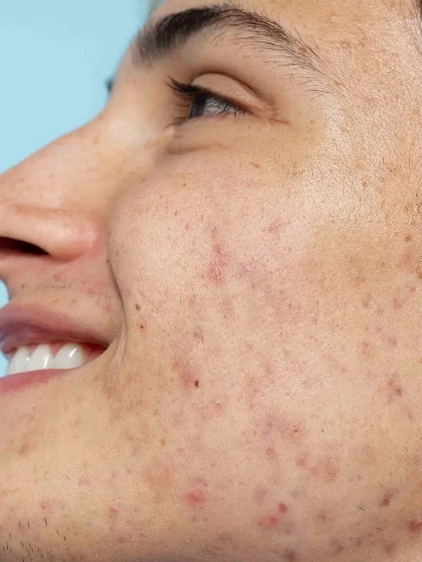 A one-size-fits-all approach cannot be implemented in the case of pimple patches since different types and severities of acne demand different treatment. Image: freepik.com 