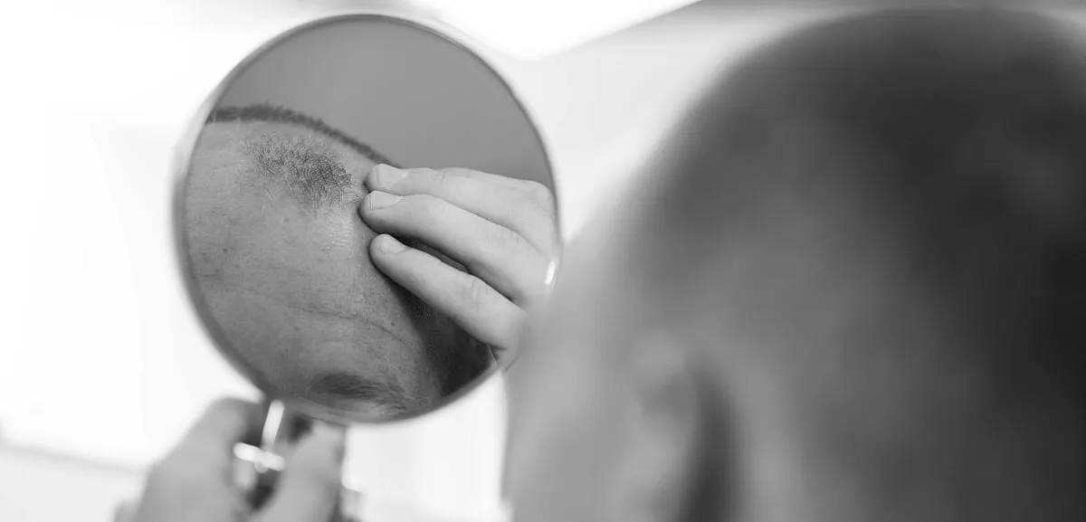 “Hair loss in men usually starts from the frontal hairline, sides of the hairline and eventually leads to the crown of the hair, whereas in women, hair thinning starts from the middle partition and gradually spreads to the sides,” says Dr Madhuri Agarwal. Image: Freepik 