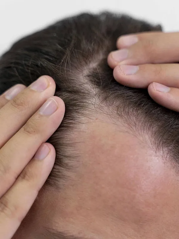 While hormonal fluctuations vary from person to person, genetics account for up to 80 per cent of a man’s predisposition to baldness. Image: Freepik 