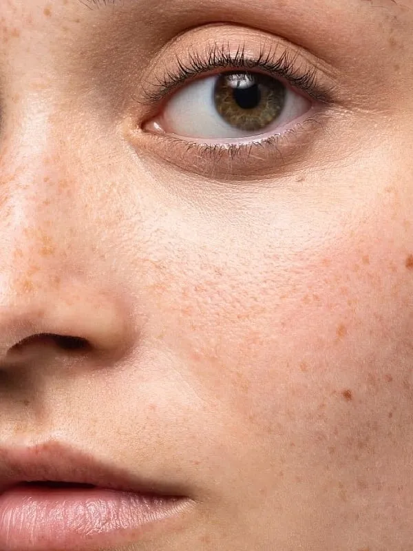 Sun exposure can worsen acne by increasing inflammation and hyperpigmentation, leading to more noticeable scars. Image: Pexels 