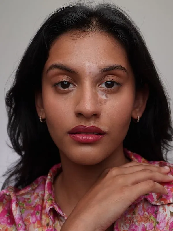 While Prarthana Jagan successfully became an advocate of vitiligo-positive skin, she now feels insecure towards her body. Image: Instagram.com/prarthanajagan 