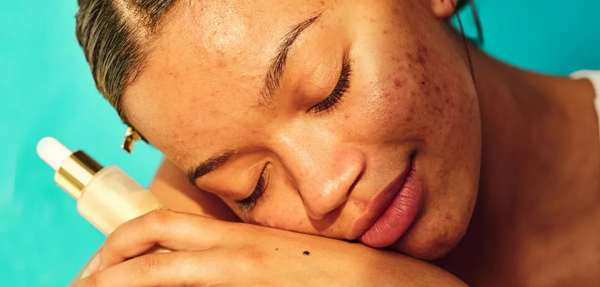 Acne is rampantly prevalent in India—as of 2022, 72.3 per cent of adolescents and 27 per cent of adults have had to deal with it. Image: Pexels 