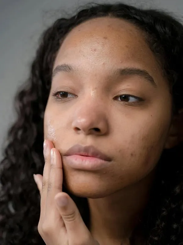 The prevalence of a psychological impact among individuals dealing with acne was as inflated as 85.5 per cent. Image: Pexels 
