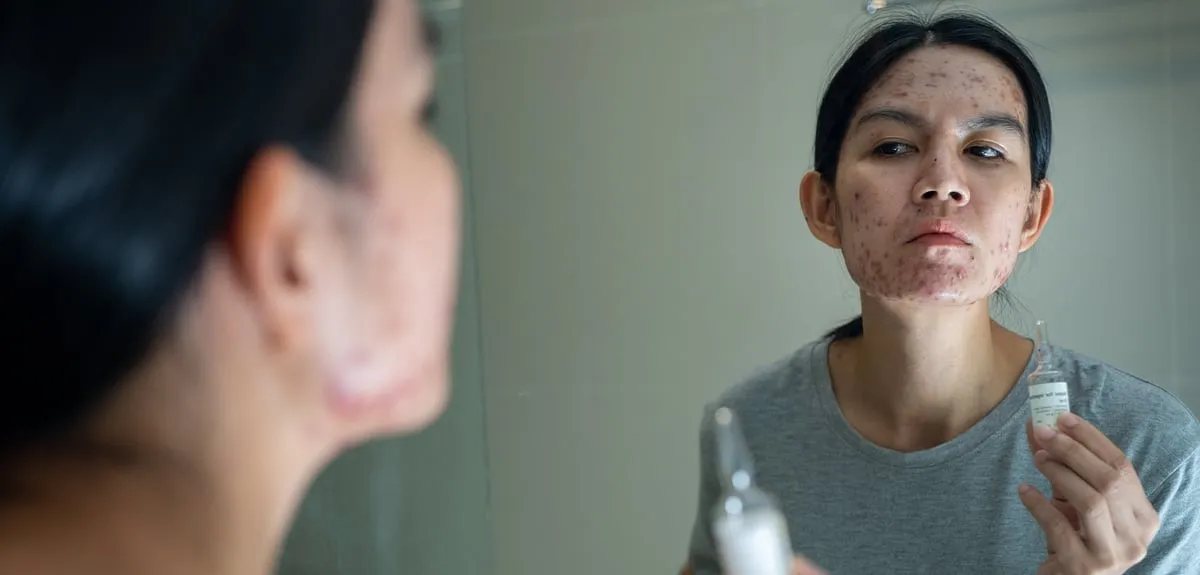 Resist the urge to pick at pimples—we all know how tempting it can be, especially when they seem so glaringly obvious on your skin. However, doing so will only exacerbate the problem, potentially causing them to spread. Image: Unsplash 