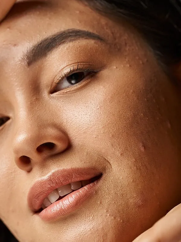 Acne occurs when hair follicles—tiny structures on the skin that house a strand of hair—become clogged. Image: Unsplash 