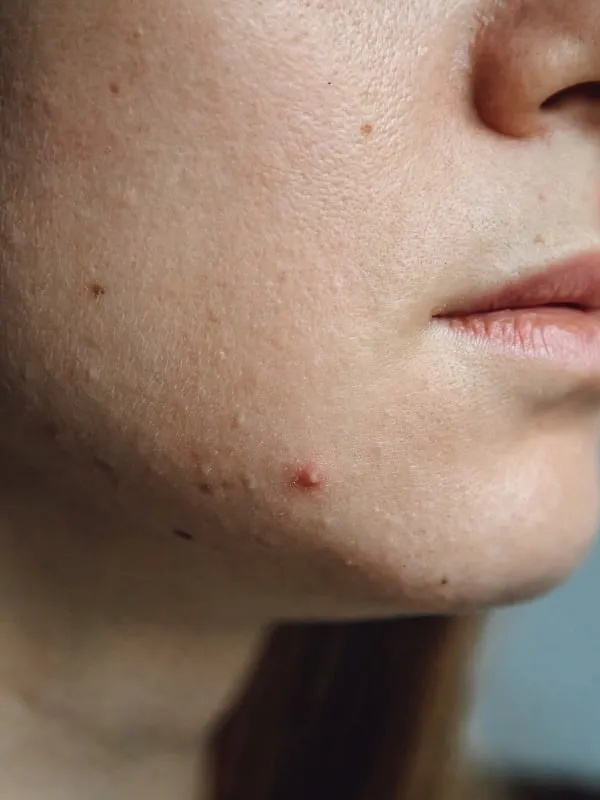 Acne often coincides with significant hormonal stages like puberty, menstruation, pregnancy, or even menopause. Image: Unsplash 