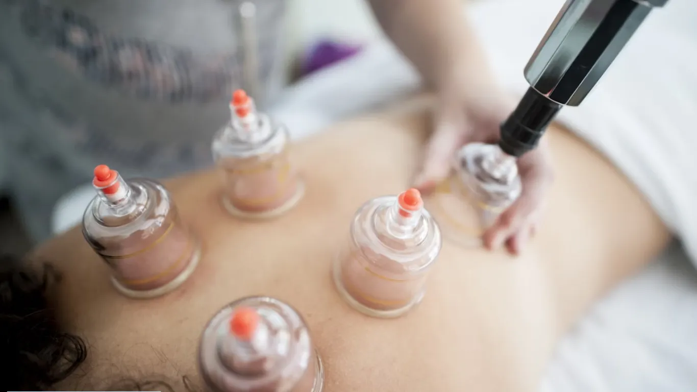 acupuncture