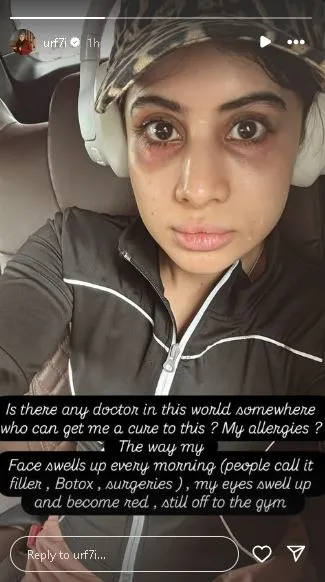Uorfi Javed swollen face