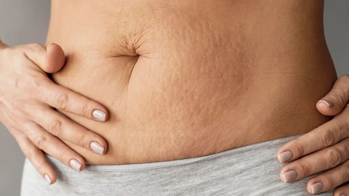 Tips To Prevent Stretch Marks 1