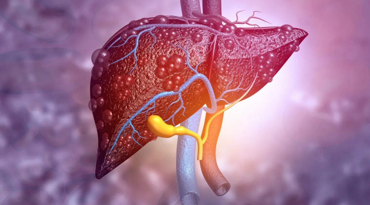liver cirrhosis