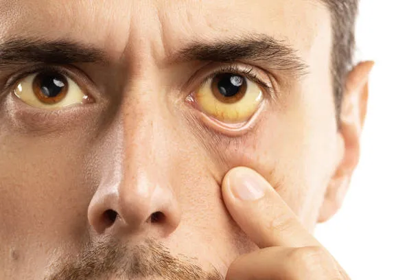jaundice