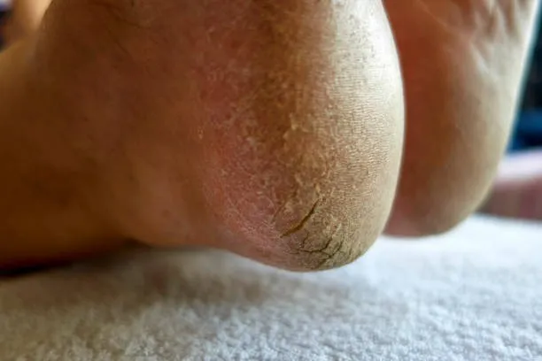 cracked heel