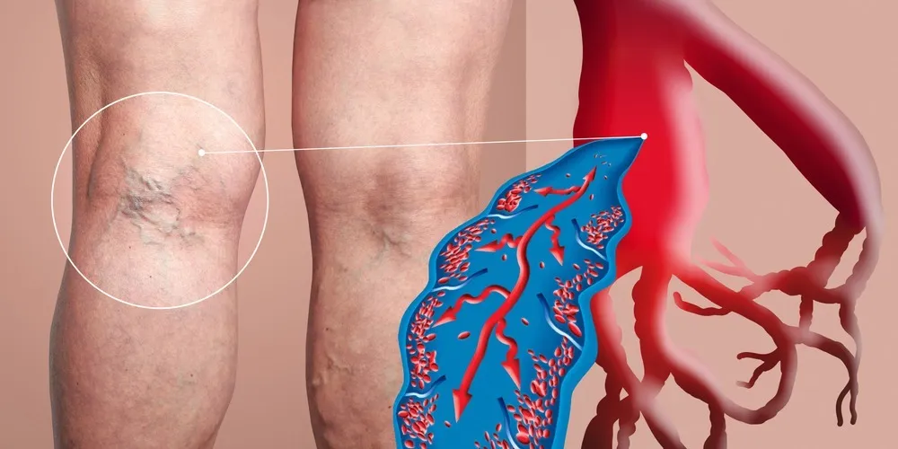 Deep-Vein-Thrombosis