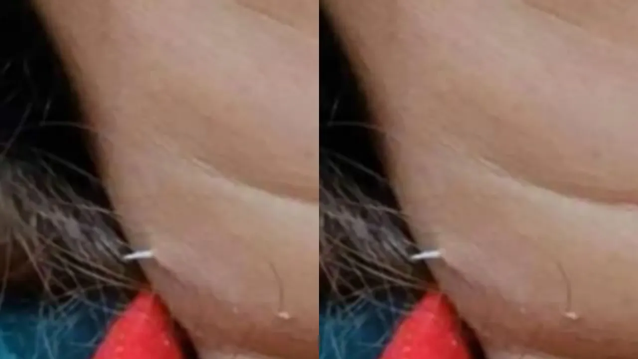 fish bone breaks through neck