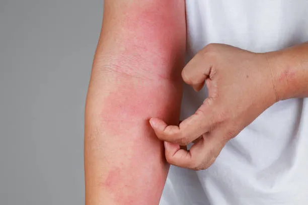 skin rashes