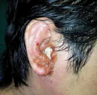 otitis externa