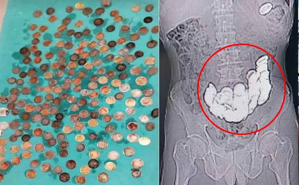 Belly turned into a bill; Doctors were shocked to see 462 rupees