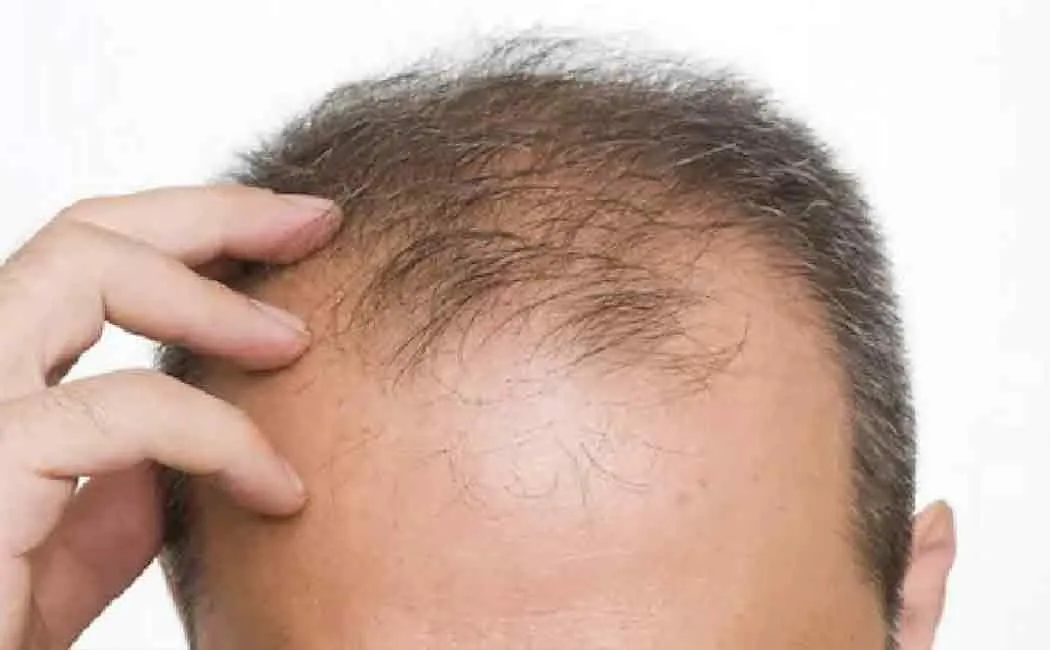 Rs.6000 monthly pension for bald heads!!