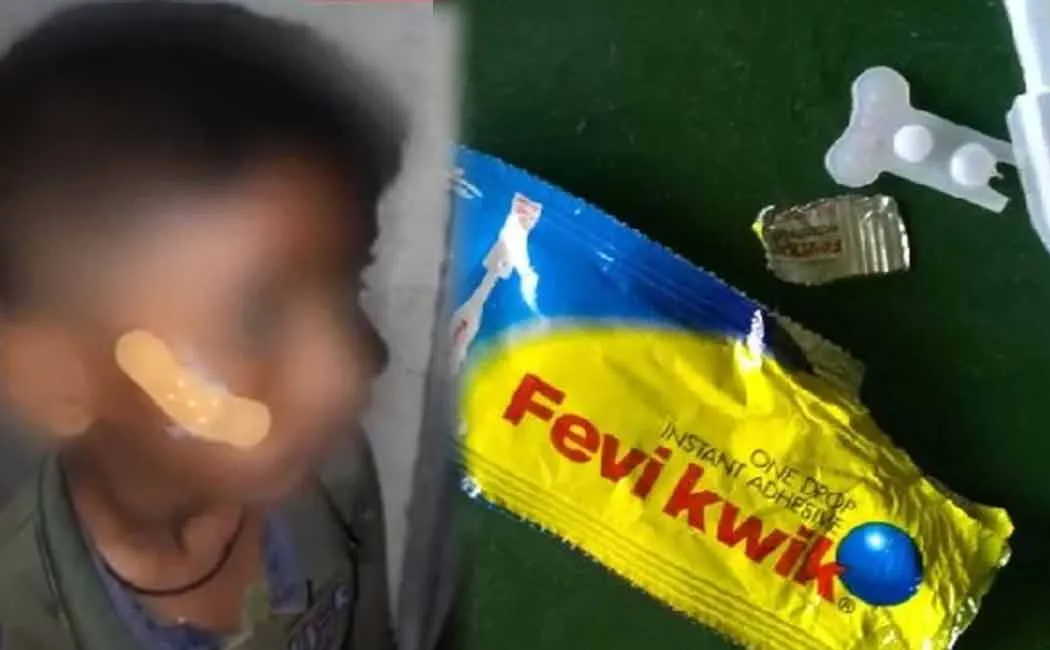 Nurse applies Fevikwik to boy with cheek injury instead of stitching  