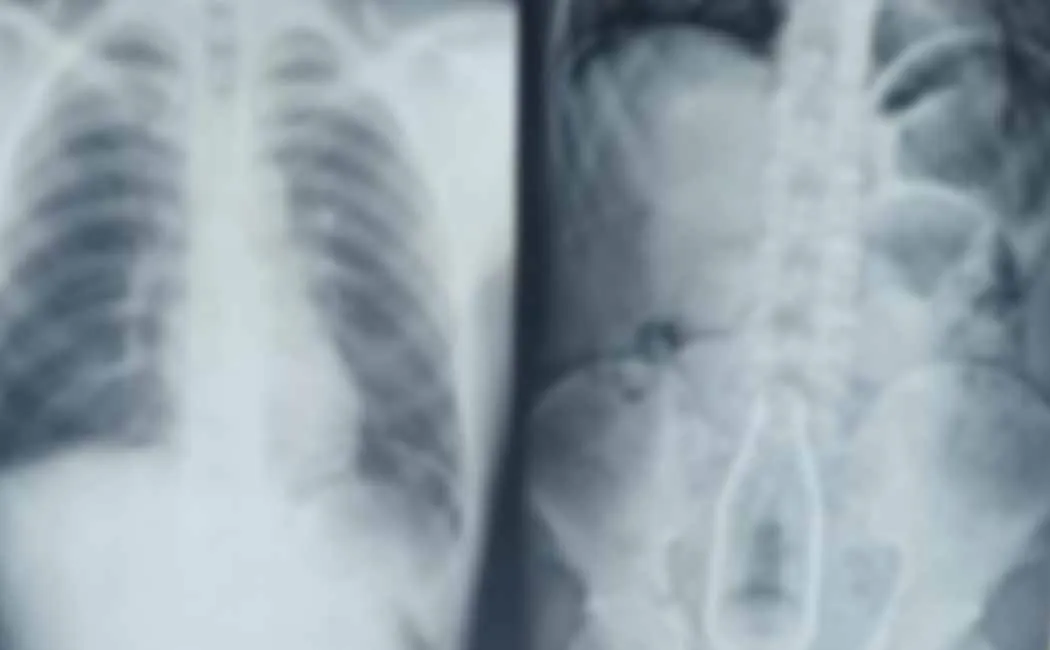 A soft drink bottle inside a disabled person's stomach The doctors were shocked