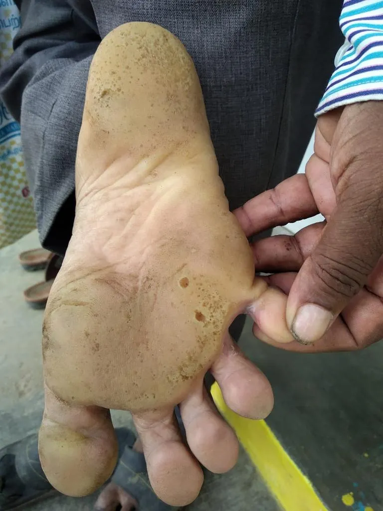 avin Adopting the thalavaipatti