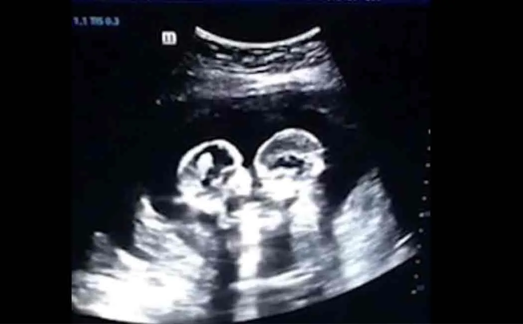 viral video of twin babies fighting inside womb 