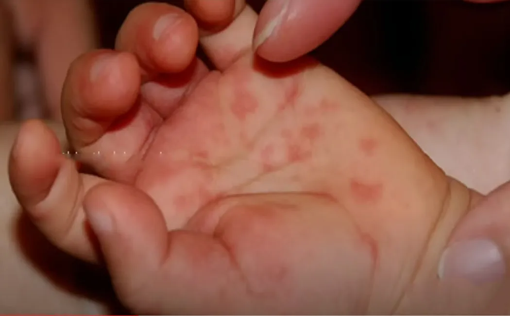 Children suffering from tomato fever!