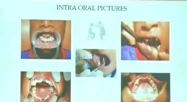  526 teeth in 7-year-old boy's mouth ... Caused by cellphone radiation?
