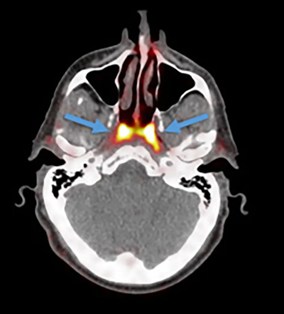 Tubarial salivary glands