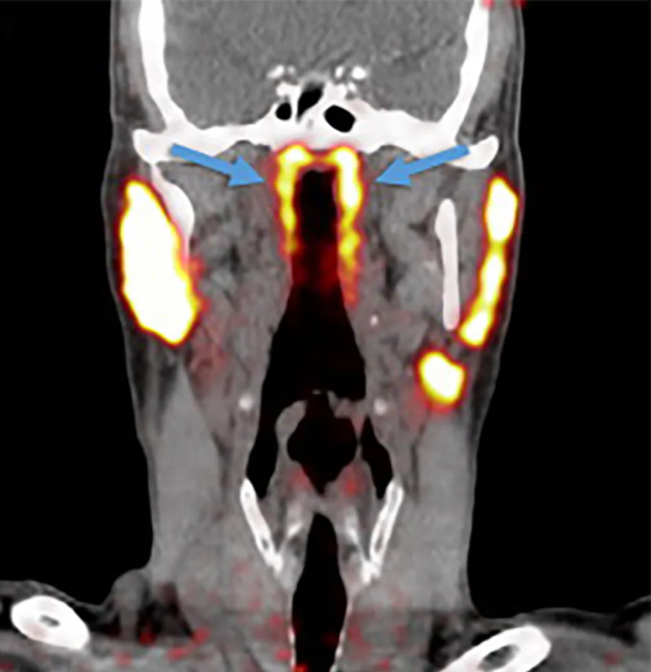 Tubarial salivary glands