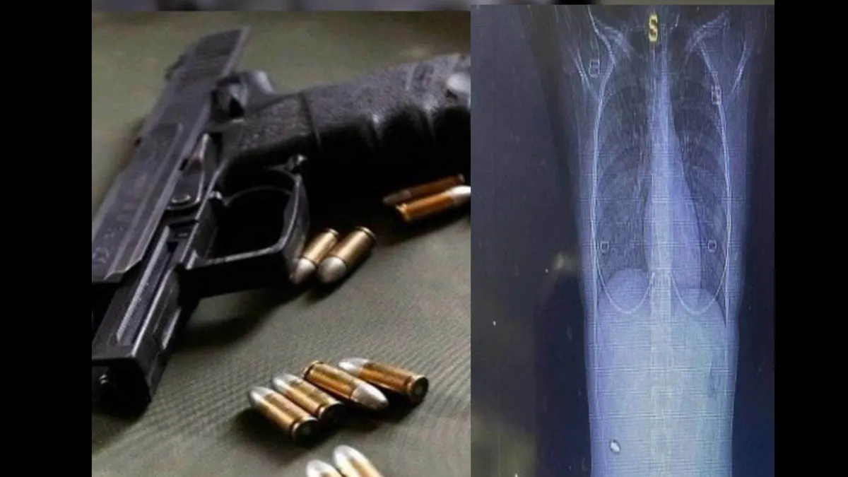 Strange woman living with bullet in back for 15 years know detail