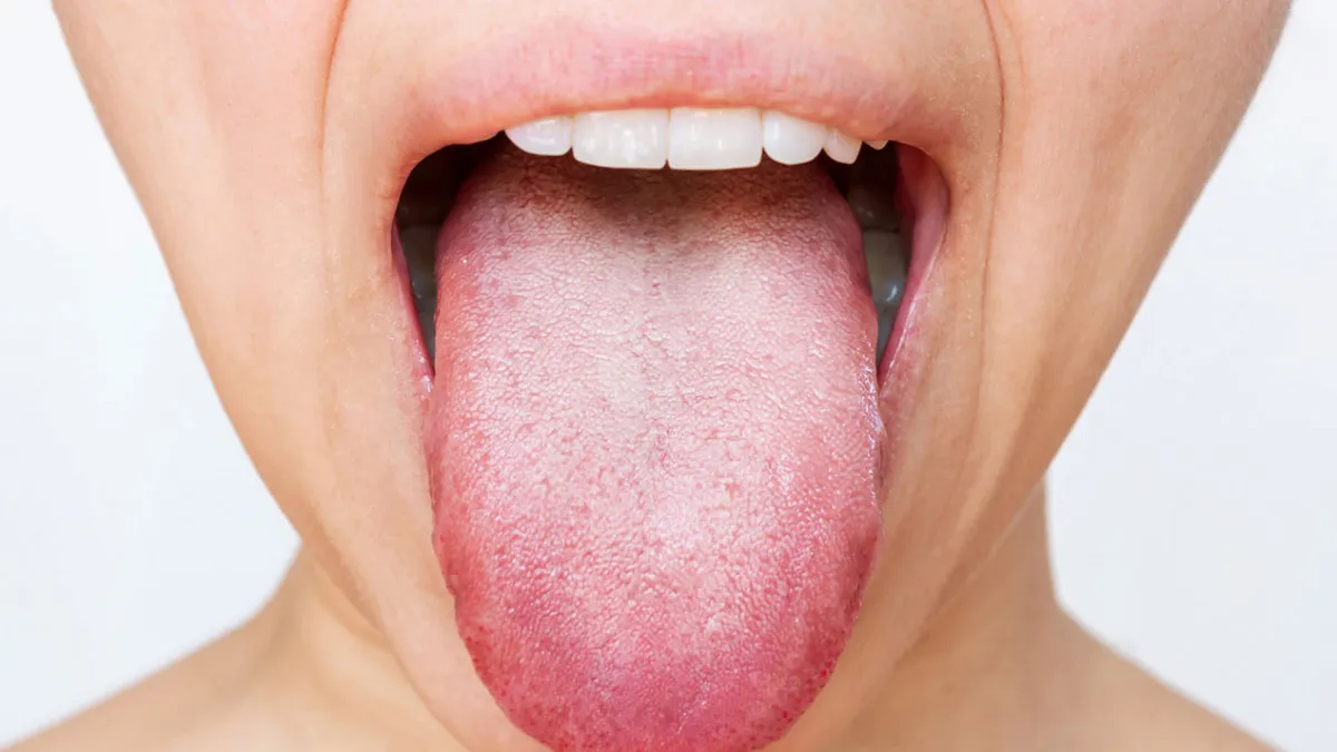 Changes in tongue color can indicate underlying health issue 