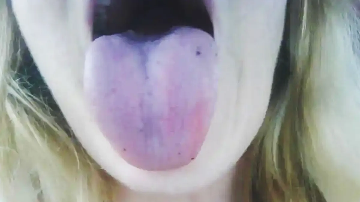Changes in tongue color can indicate underlying health issue 