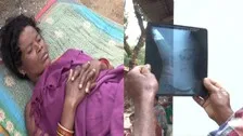 Odisha: Doctor Leaves Broken Needle In Woman's Uterus During Family Planning Operation In Koraput